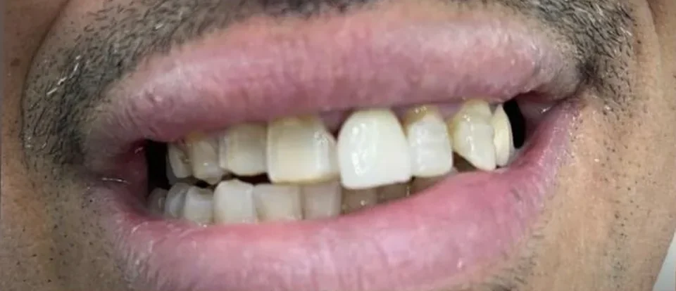 الابتسامة قبل العلاج — الحالة الثانية