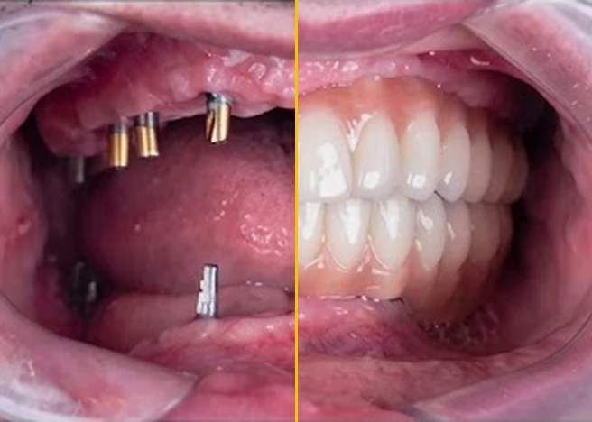 Immediate implants: half of the photo shows the implants before the teeth are fitted, half after — illustrative case