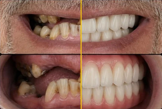 Conventional implants: half of the photo before treatment, half after