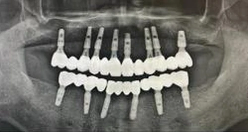 صورة أشعة بانورامية بعد زراعة فك كامل — حالة توضيحية من Dr. Mark Kwon
